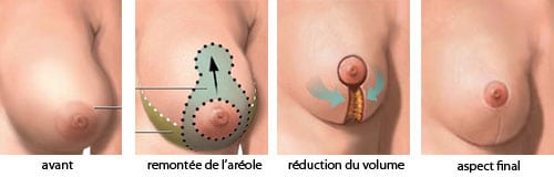 reduction mammaire tunisie